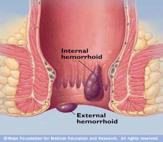 Common Symptoms of Bleeding hemorrhoids